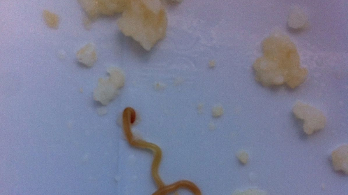 Il verme nel riso scoperto da una paziente ricoverata a Cisanello