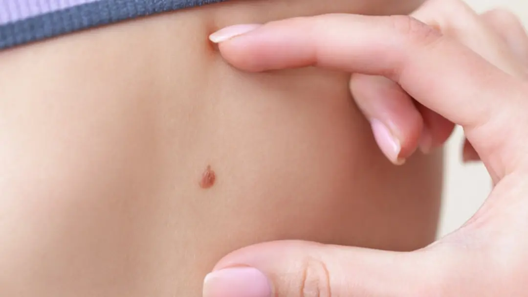 Visita dermatologica (foto Ansa) 