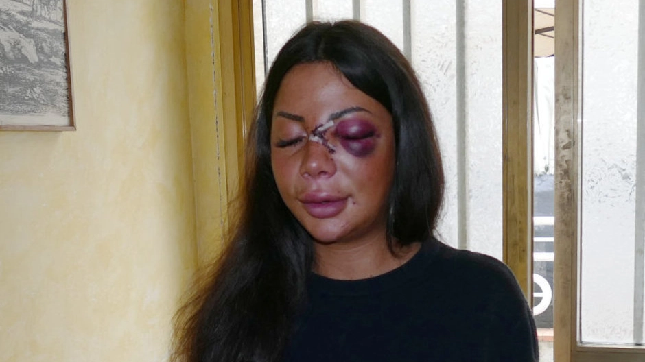 Martina Mucci il giorno dopo la brutale aggressione (foto d’archivio)