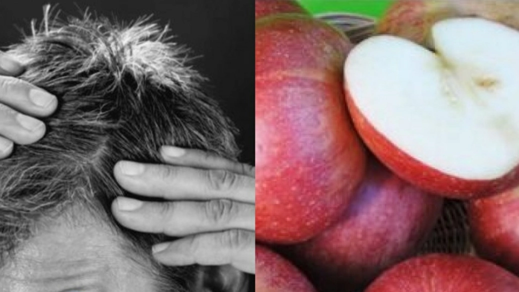 Caduta capelli e mele Annurca (foto Ansa) Caduta capelli e mele Annurca (foto Ansa)