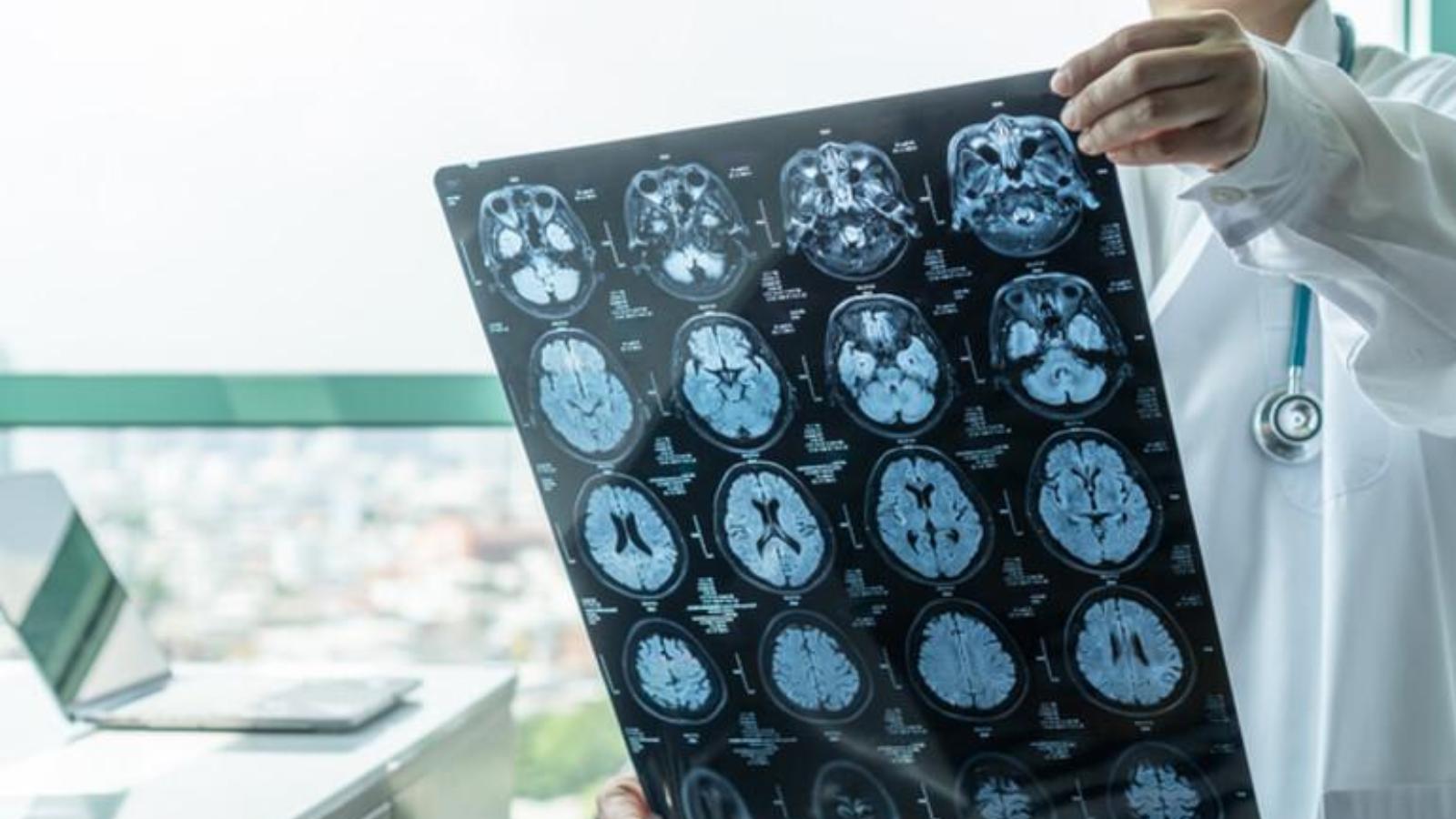 Nuove speranze post ictus: impulsi elettrici per “riaccendere” il cervello Nuove speranze post ictus: impulsi elettrici per “riaccendere” il cervello