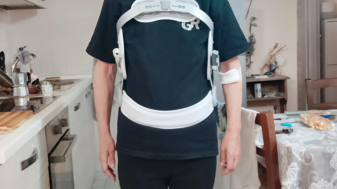 frattura non diagnosticata il mio incubo alla fratta da Lanazione.it frattura non diagnosticata il mio incubo alla fratta
