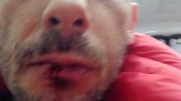 Andrea Drago con i segni dei pugni ricevuti sul treno: è conosciuto come tifoso dell’Arezzo e quartierista di Porta del Foro Andrea Drago con i segni dei pugni ricevuti sul treno: è conosciuto come tifoso dell’Arezzo e quartierista di Porta del Foro